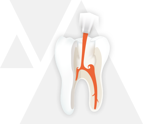 endodontie step 5