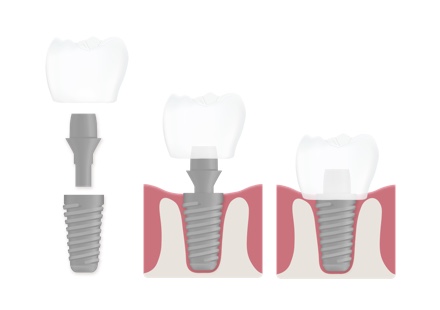 zahnersatz implantate